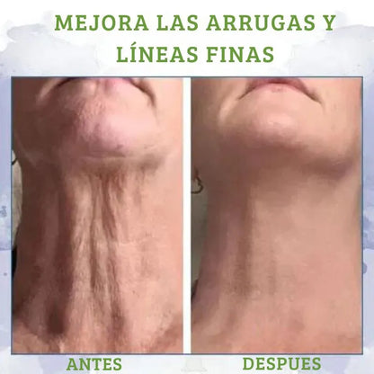 Crema reafirmante para el cuello para pieles con acné